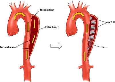 Case Report: The application of amplatzer vascular plug to repair aortic dissection intimal tears and false lumen